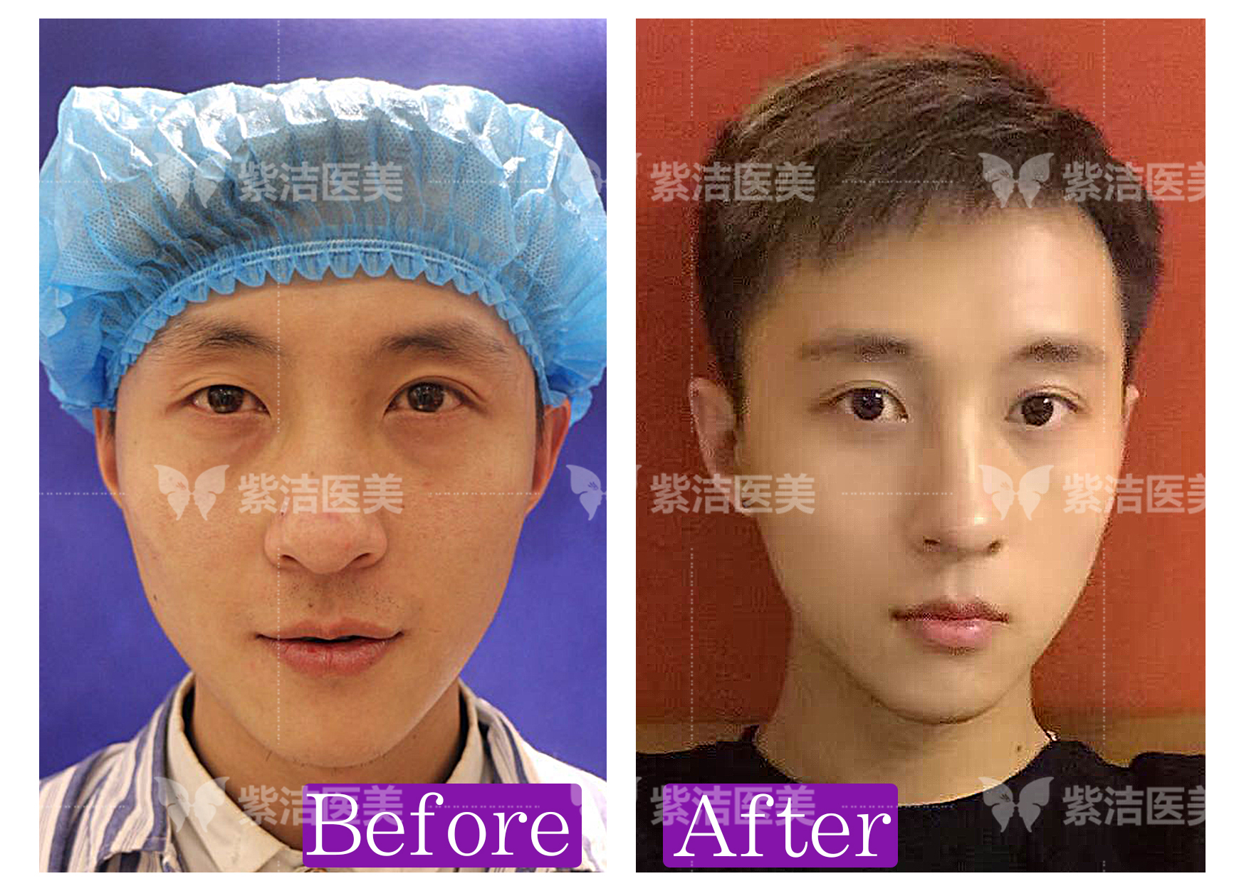 專精的術(shù)前設(shè)計