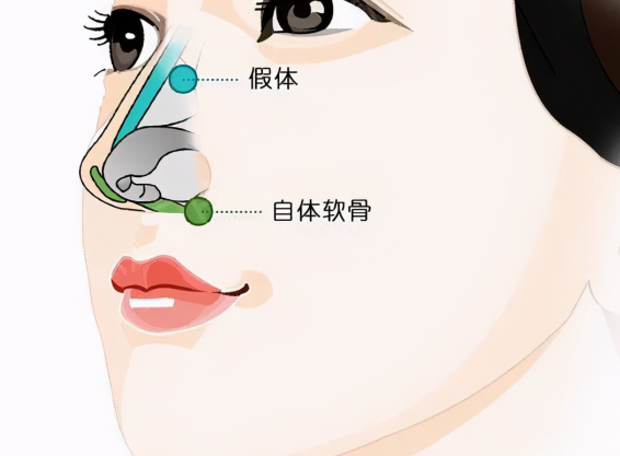 上海張朋浩微駝峰鼻實例展示