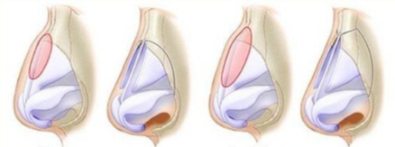 選擇張朋浩醫(yī)生進行微駝峰鼻整形的理由