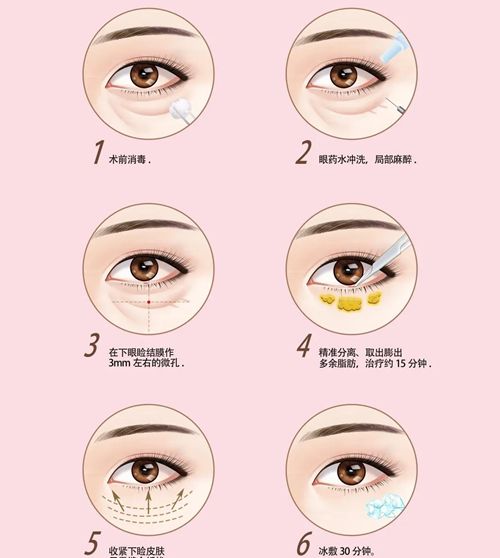 保定內(nèi)切眼袋比較好的醫(yī)生