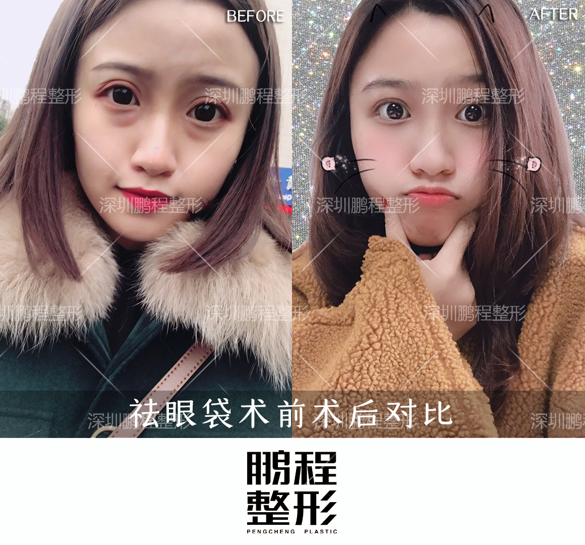 激光去眼袋優(yōu)勢