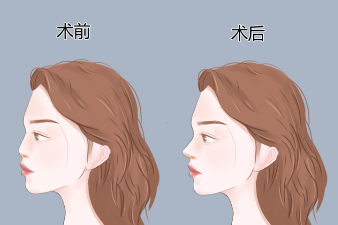 選擇潘峰做鼻整形，需要注意什么？