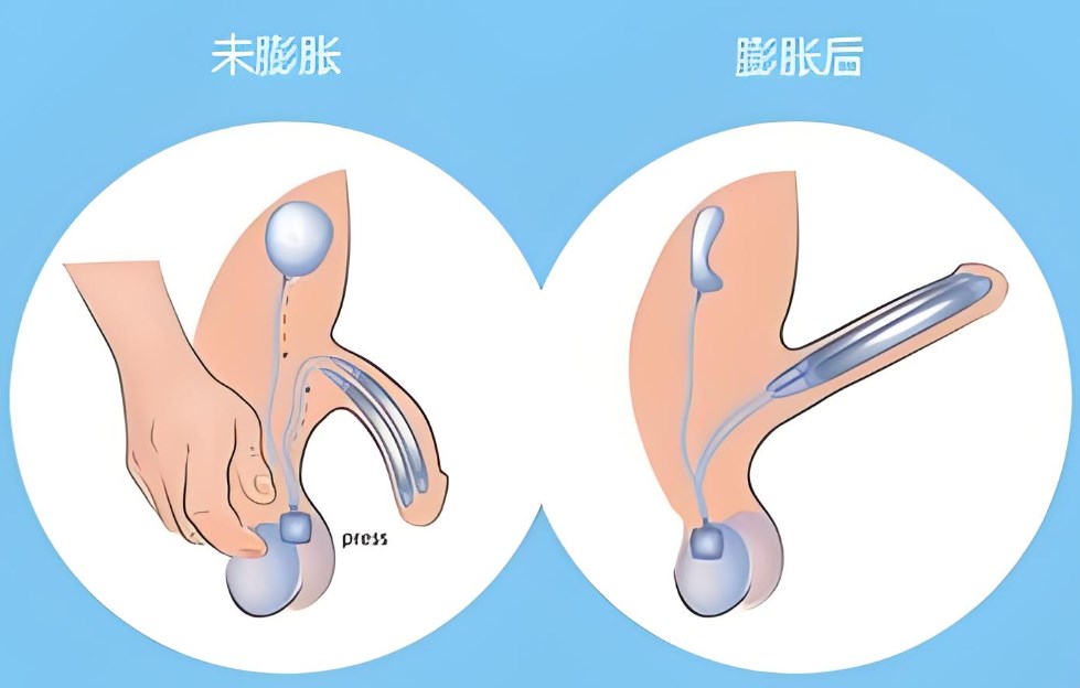 六、假體三件套術(shù)后護理與變好要點