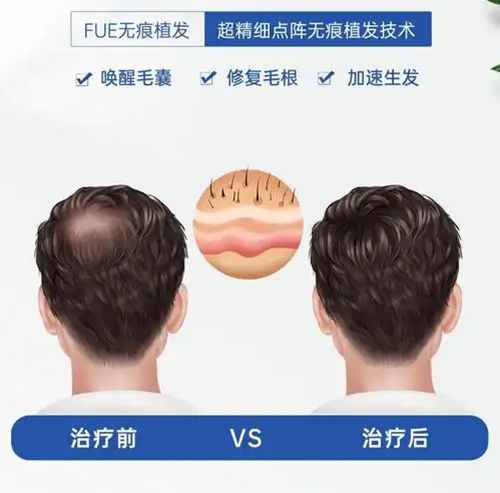 二、發(fā)際線修復(fù)另計是怎么回事