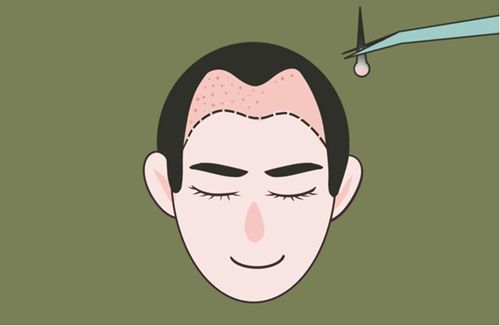 三、植發(fā)鬢角收費透明度怎么樣