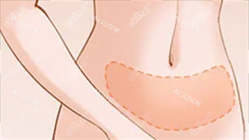 重慶軍美唐國(guó)強(qiáng)吸脂口碑實(shí)測(cè)：分層吸脂技術(shù)特點(diǎn)與真實(shí)反饋評(píng)價(jià)