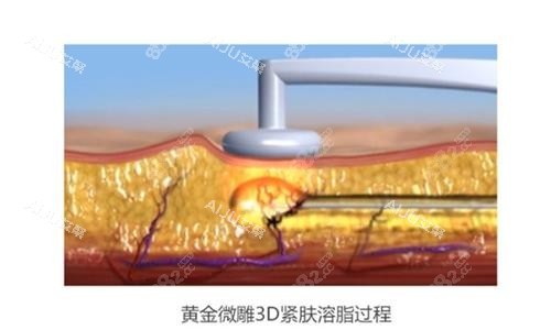 黃金微雕示意圖