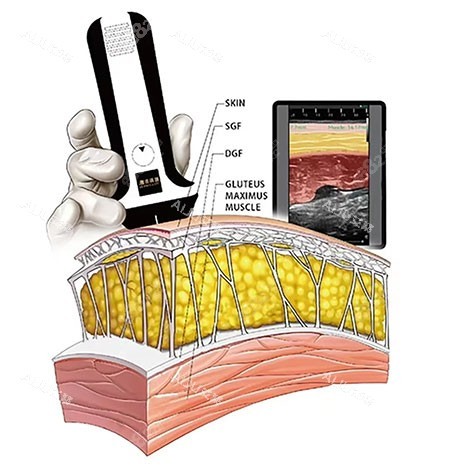 維密金雕原理示意圖