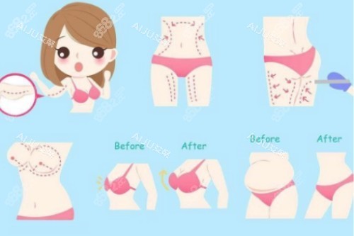 吸脂塑形卡通概念圖 吸脂塑形卡通概念圖