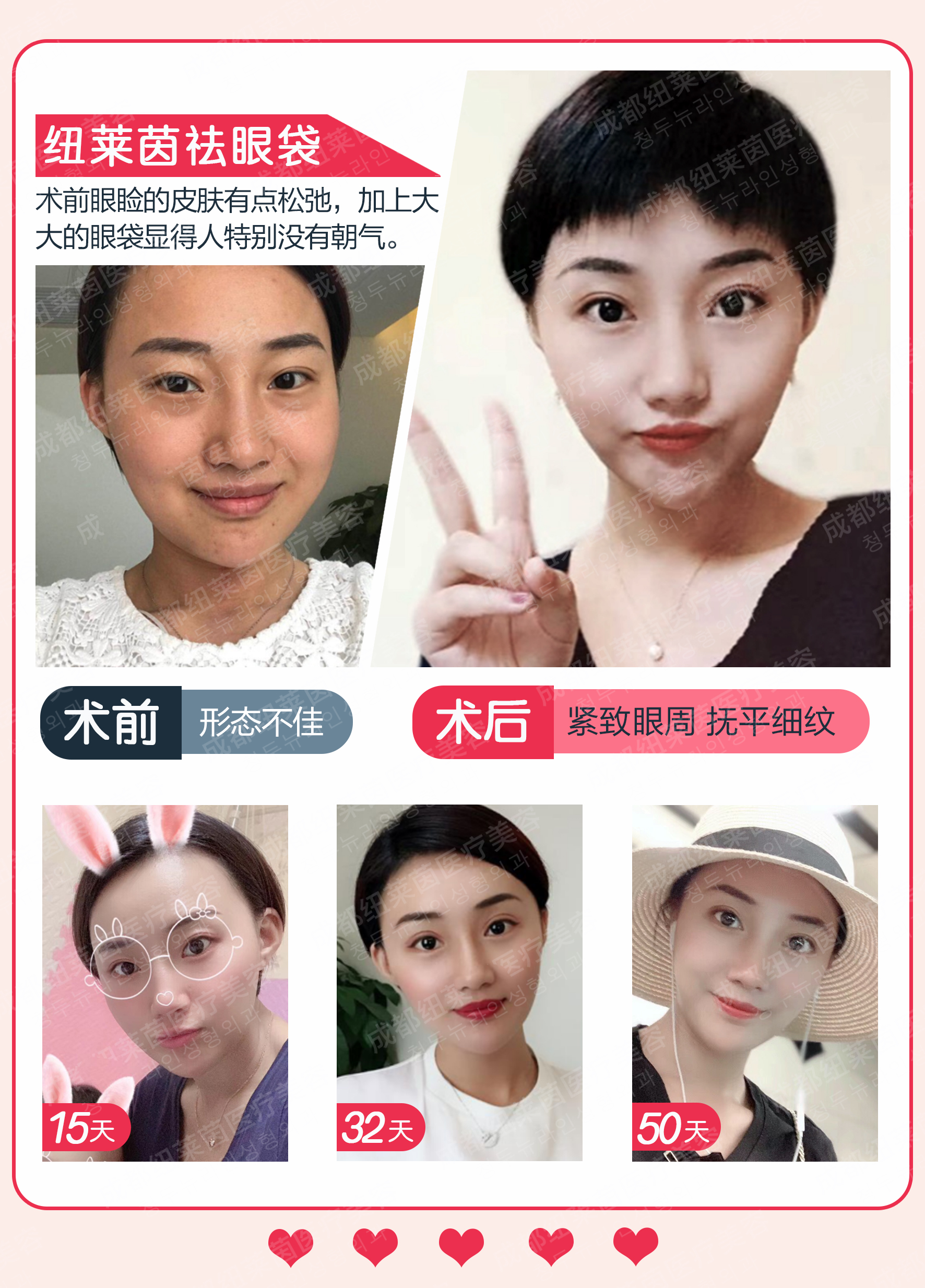 西安美萊去眼袋方式多樣www.sorencai.cn