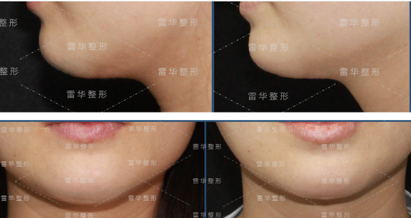 雷華醫(yī)生脂肪取出對比圖