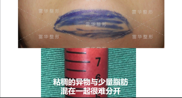 雷華醫(yī)生脂肪取出對比圖