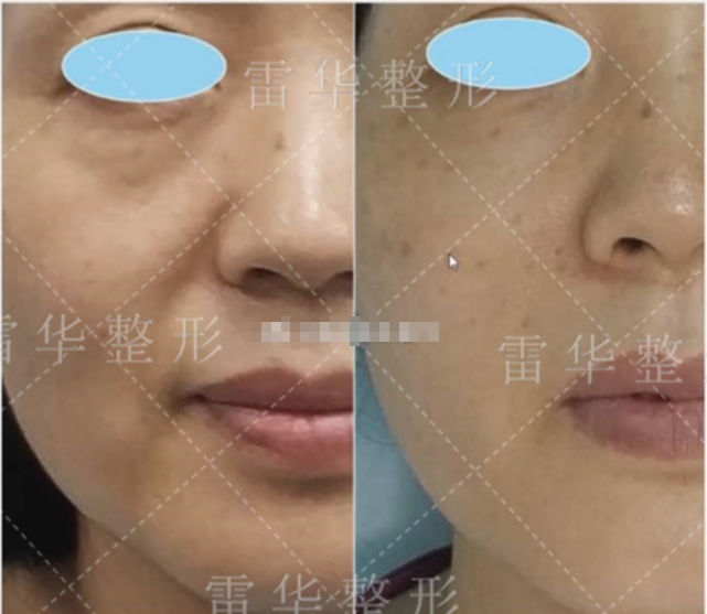 雷華醫(yī)生脂肪取出對比圖