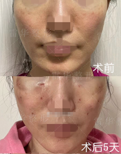 雷華醫(yī)生脂肪取出對比圖