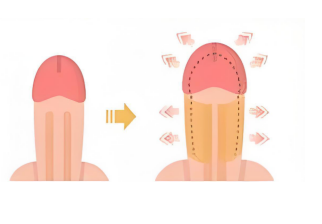 2. 陰莖增粗術(shù)（自體脂肪注射）