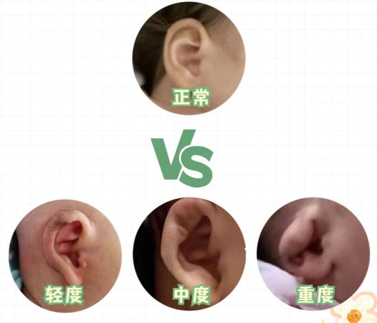 一、于曉波杯狀耳修復實例分型解析（輕度/中度/重度全覆蓋）www.sorencai.cn