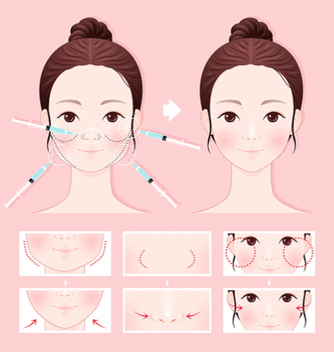 二、艾莉薇玻尿酸的類型及吸收時(shí)間