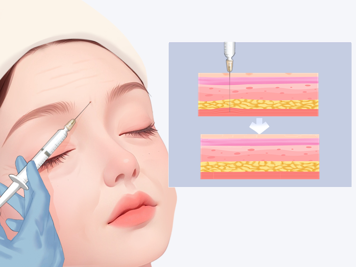 四、注射后3年未吸收的情況分析