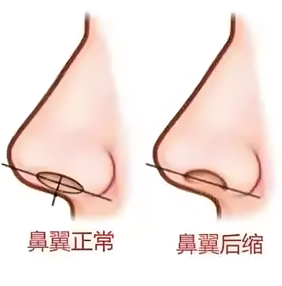 二、縮鼻翼手術(shù)的療效與風險分析