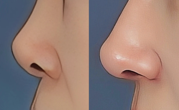 四、如何判斷上海徐麗芬縮鼻翼是否靠譜