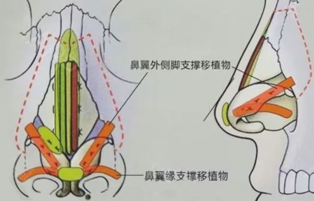 五、縮鼻翼手術(shù)的注意事項