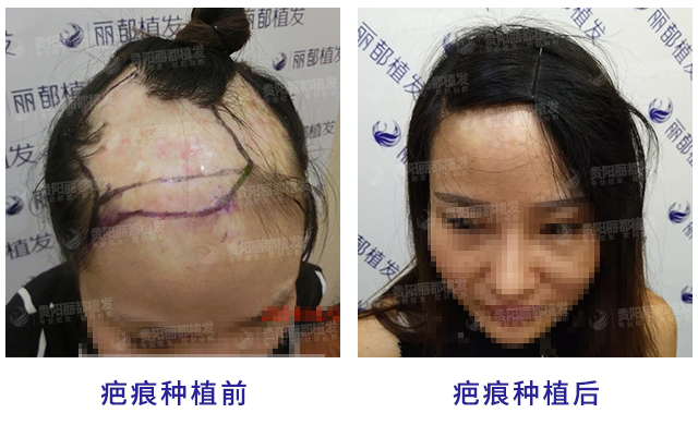 福州重森植發(fā)：CUE技術(shù)顯優(yōu)勢(shì)