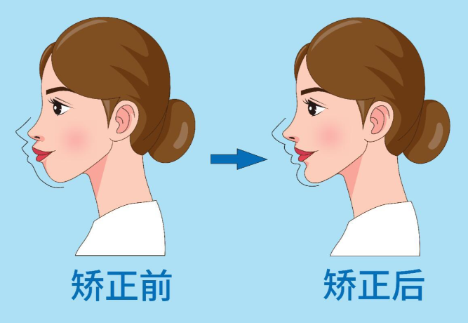 找王濤醫(yī)生做正頜注意事項(xiàng)