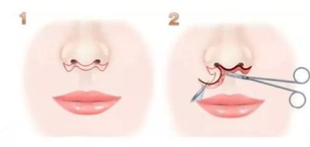 術前精心規(guī)劃，降低增生風險