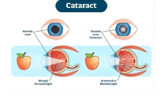 白內(nèi)障手術(shù)后5年后的親身經(jīng)歷：患者有哪些建議？