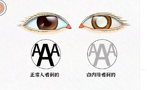 三、老年人白內(nèi)障為什么不建議手術(shù)之手術(shù)風(fēng)險(xiǎn)評估