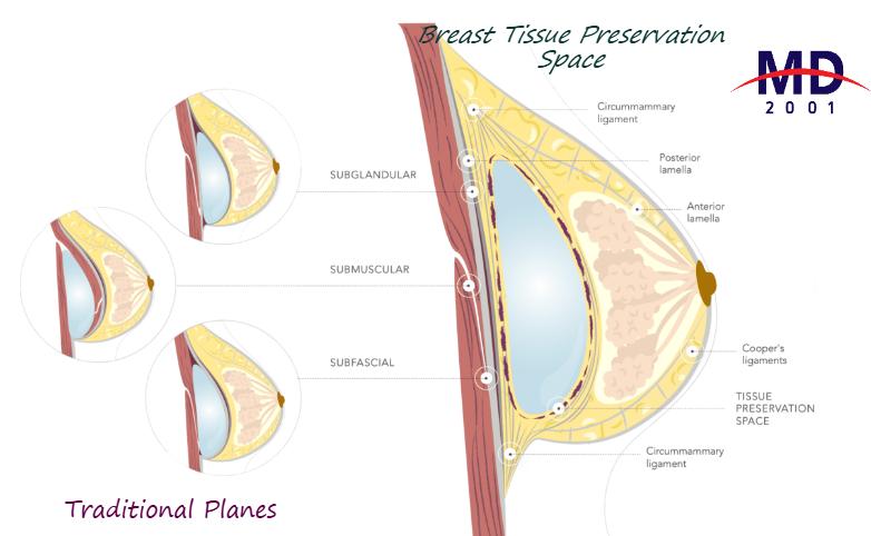 王子俊2025豐胸方案：從“標準化”到“高定”，適配不同基礎