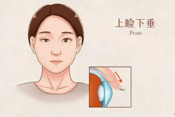 黃丹平醫(yī)生做上瞼下垂修復(fù)好嗎