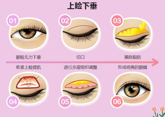 黃丹平醫(yī)生上瞼下垂修復(fù)的患者反饋:真實(shí)評價(jià)里的療效細(xì)節(jié)