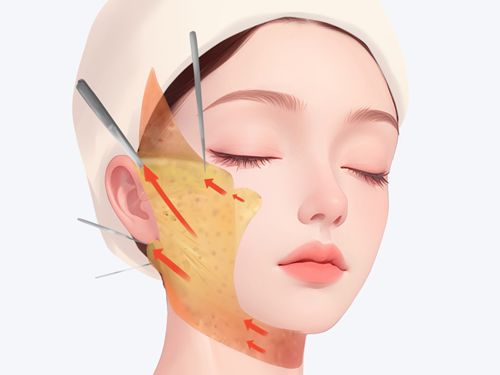 呂煒亮面部提升費用一覽表有嗎