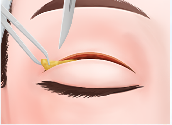 白永輝和白明做雙眼皮誰膩害？