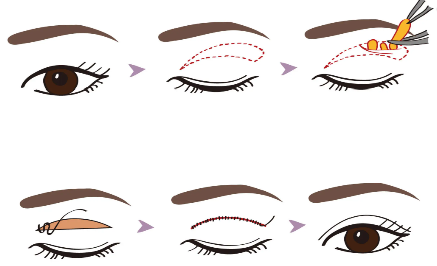 白永輝和白明做雙眼皮的對比分析