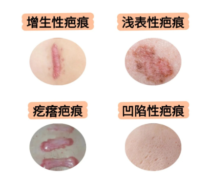 在云南做疤痕修復(fù)哪家醫(yī)院好？這三家技術(shù)和服務(wù)雙優(yōu)，價(jià)格也劃算