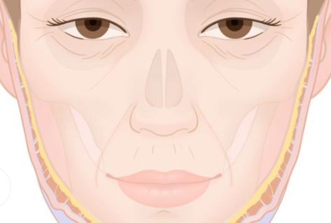 朱慧東異物取出是乳化還是汽化呢