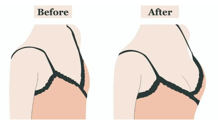 重慶華美張梅假體隆胸術(shù)后3個月真實反饋