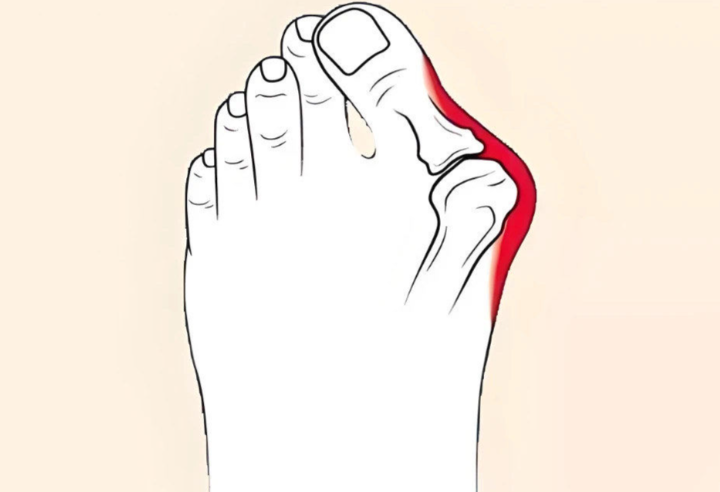 二、如何選擇適合自己的拇外翻治療醫(yī)院？www.sorencai.cn