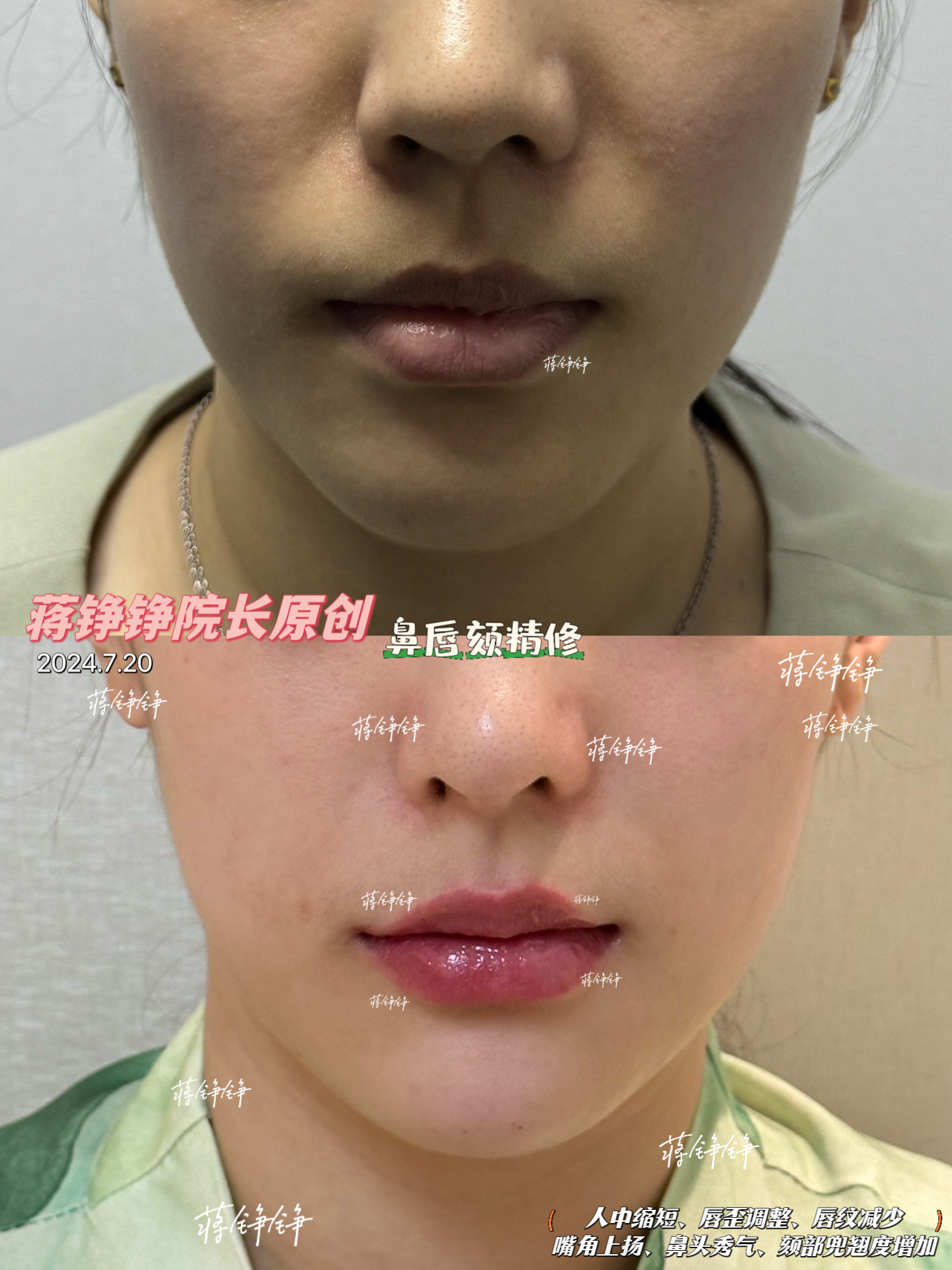 我親歷杭州美萊栗勇做胸的手術(shù)全程體驗