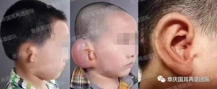 欒杰醫(yī)生乳房再造手術(shù)技術(shù)優(yōu)勢(shì)：創(chuàng)新與安心并存