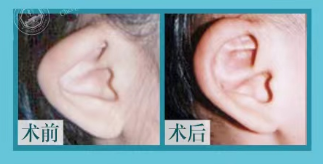 看我親歷八大處欒杰的手術(shù)全程體驗(yàn)及術(shù)后成效分享