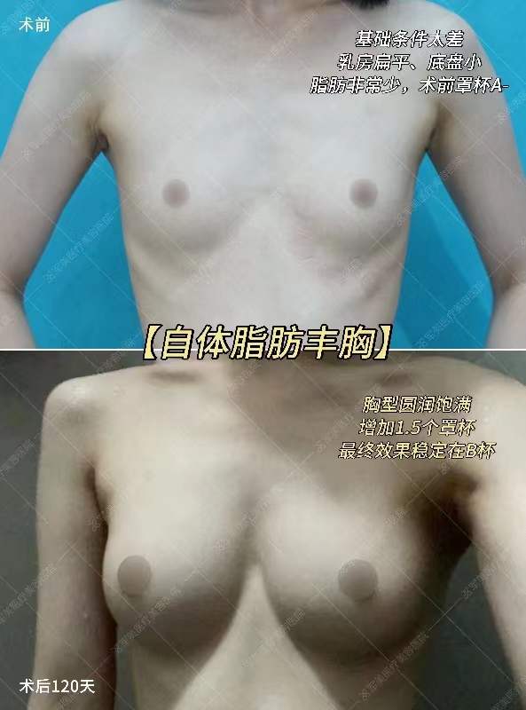 二、謝衛(wèi)國不同類型假體隆胸價格