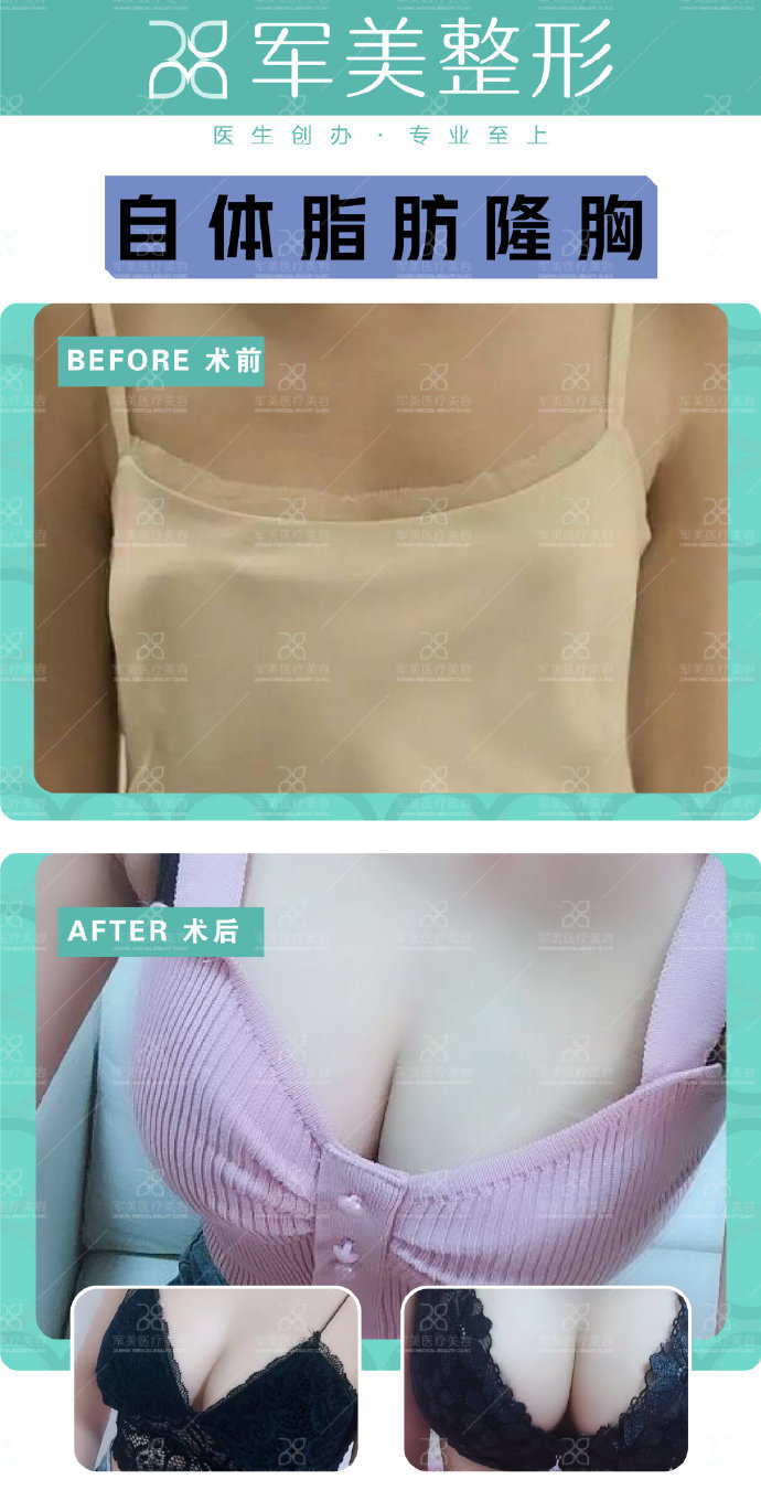 四、謝衛(wèi)國不同難度胸修復(fù)價格