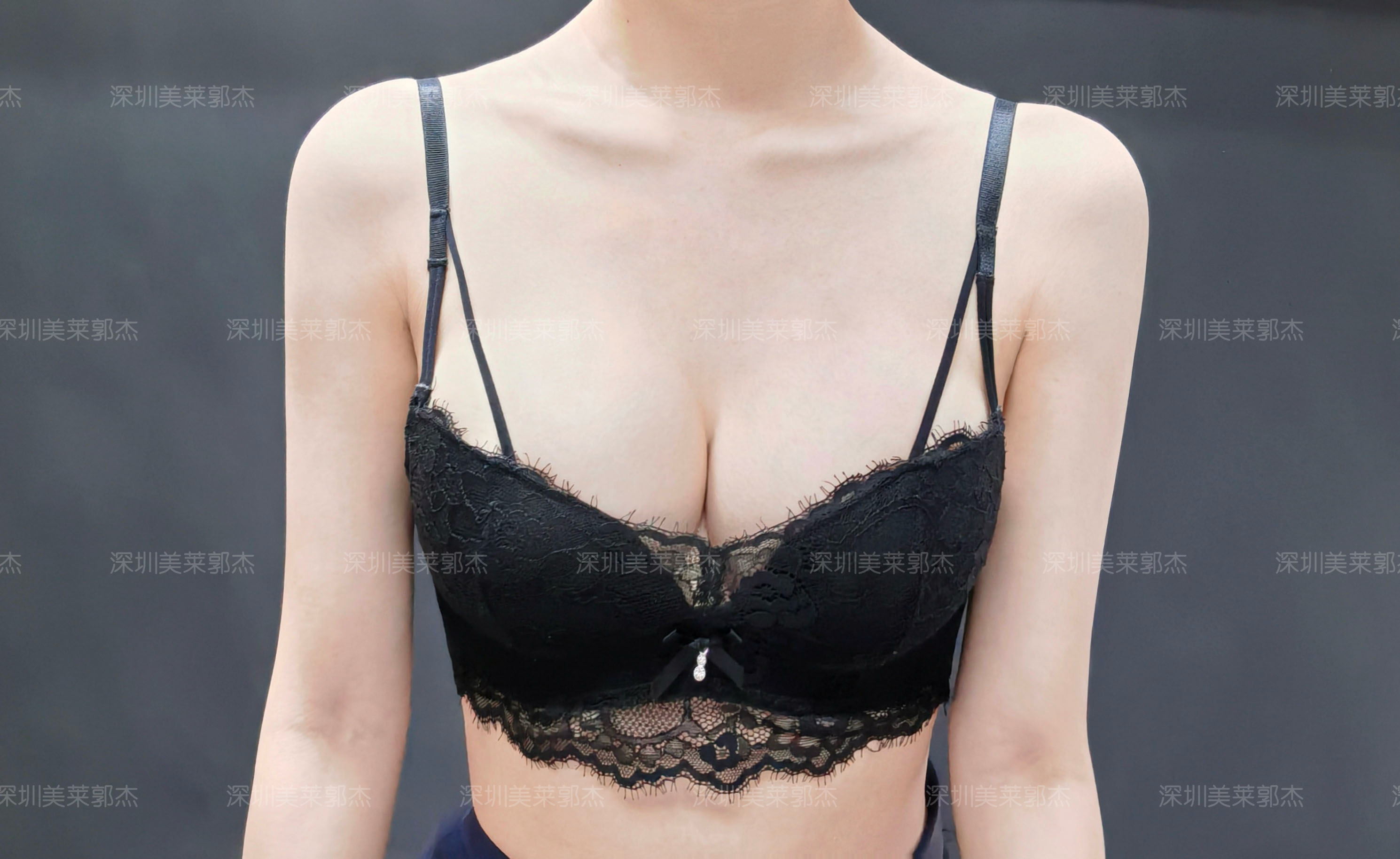 四、成都軍大梁軍胸部整形技術(shù)優(yōu)勢