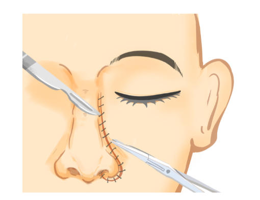 鼻子皮膚薄怎么調(diào)整？李曉平醫(yī)生3種鼻整形方案解析，深圳美萊案例真實(shí)分享
