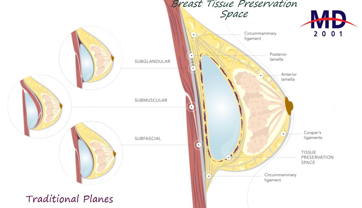 二、八大處欒杰不同材質(zhì)假體隆胸價(jià)格及優(yōu)勢(shì)