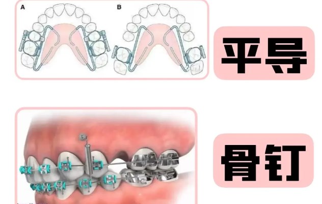 一、成都正雅隱形矯正價格概覽