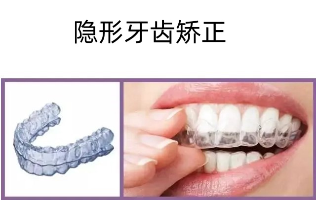 三、成都正雅隱形矯正不同版本的適用情況